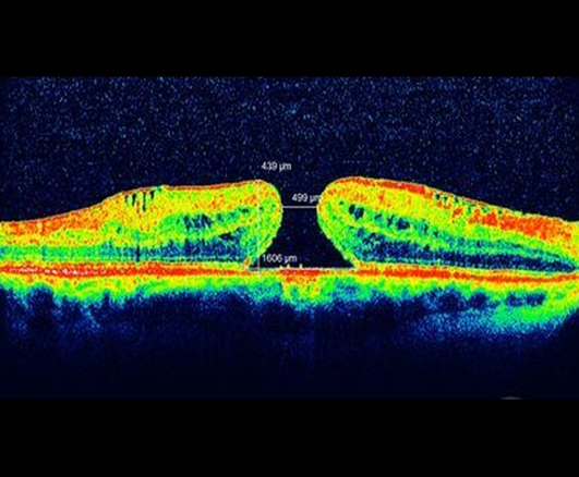 Курганский областной госпиталь для ветеранов войн: Инновационный метод хирургического лечения центральных разрывов сетчатки с применением тромбоцитарной массы 