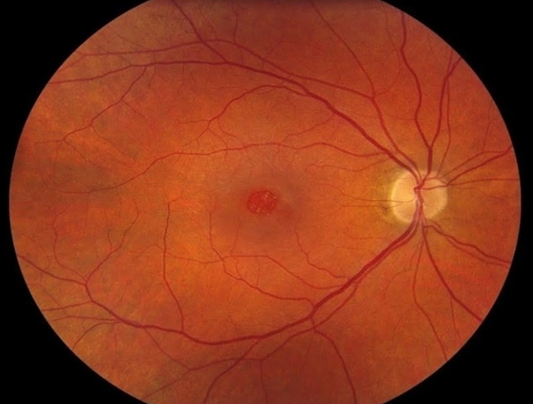 Курганский областной госпиталь для ветеранов войн: Инновационный метод хирургического лечения центральных разрывов сетчатки с применением тромбоцитарной массы 